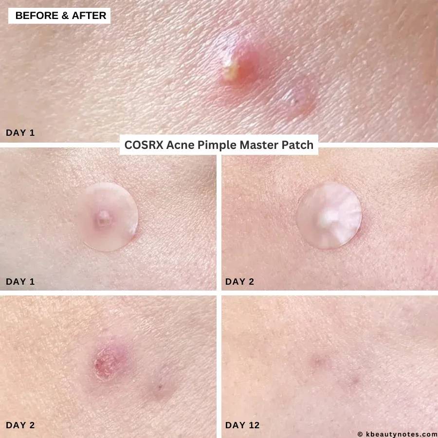 پچ درمان جوش مناسب انواع پوست کوزارکس Cosrx Acne Pimple Master patch